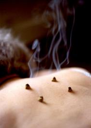 moxibustion directa acupuntura valencia