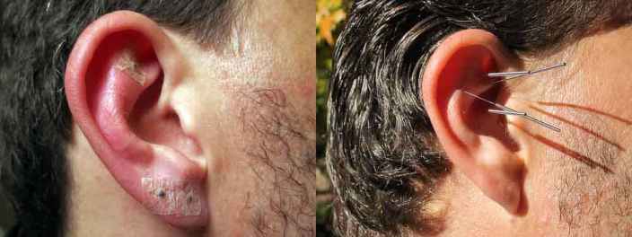 auriculoterapia para perder peso