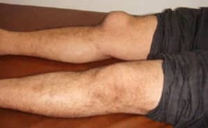 rodilla con bursitis parece una foto