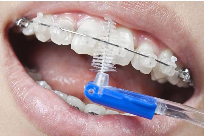 Cepillo De Dientes Para Brackets ⋆ Odontología