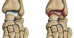 Artritis postraumática