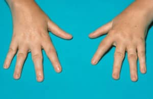 artritis juvenil idiopática en niños