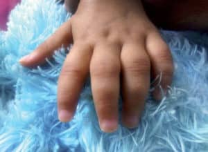 ¿Por qué se hincha la mano de un niño y cómo tratarla?