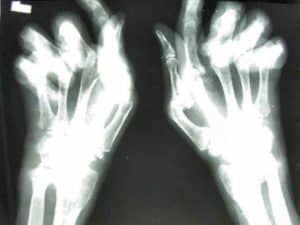 La manifestación de la fotografía de rayos X de la enfermedad.