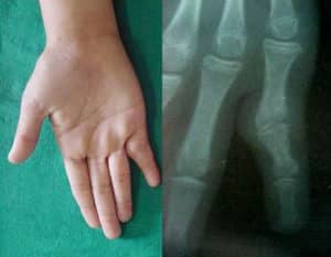 tratamiento de anquilosis