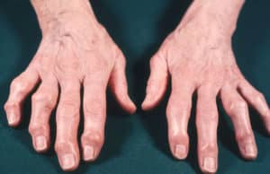 síntomas de la artritis