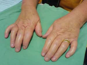 todo sobre la artropatía