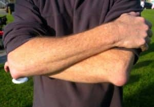 ejemplo de foto de bursitis cubital