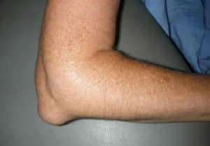 prevención de bursitis