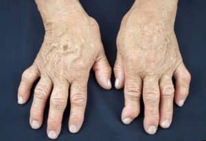 síntomas, diagnóstico, tratamiento de la forma reumatoide